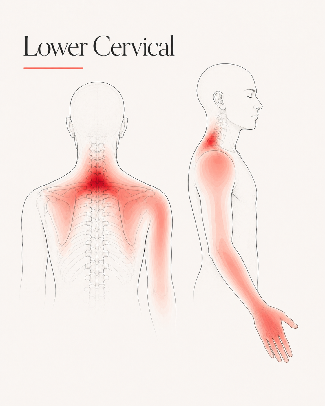 Lower Cervical pain pattern