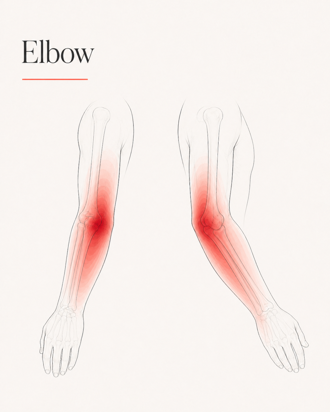 Elbow pain pattern