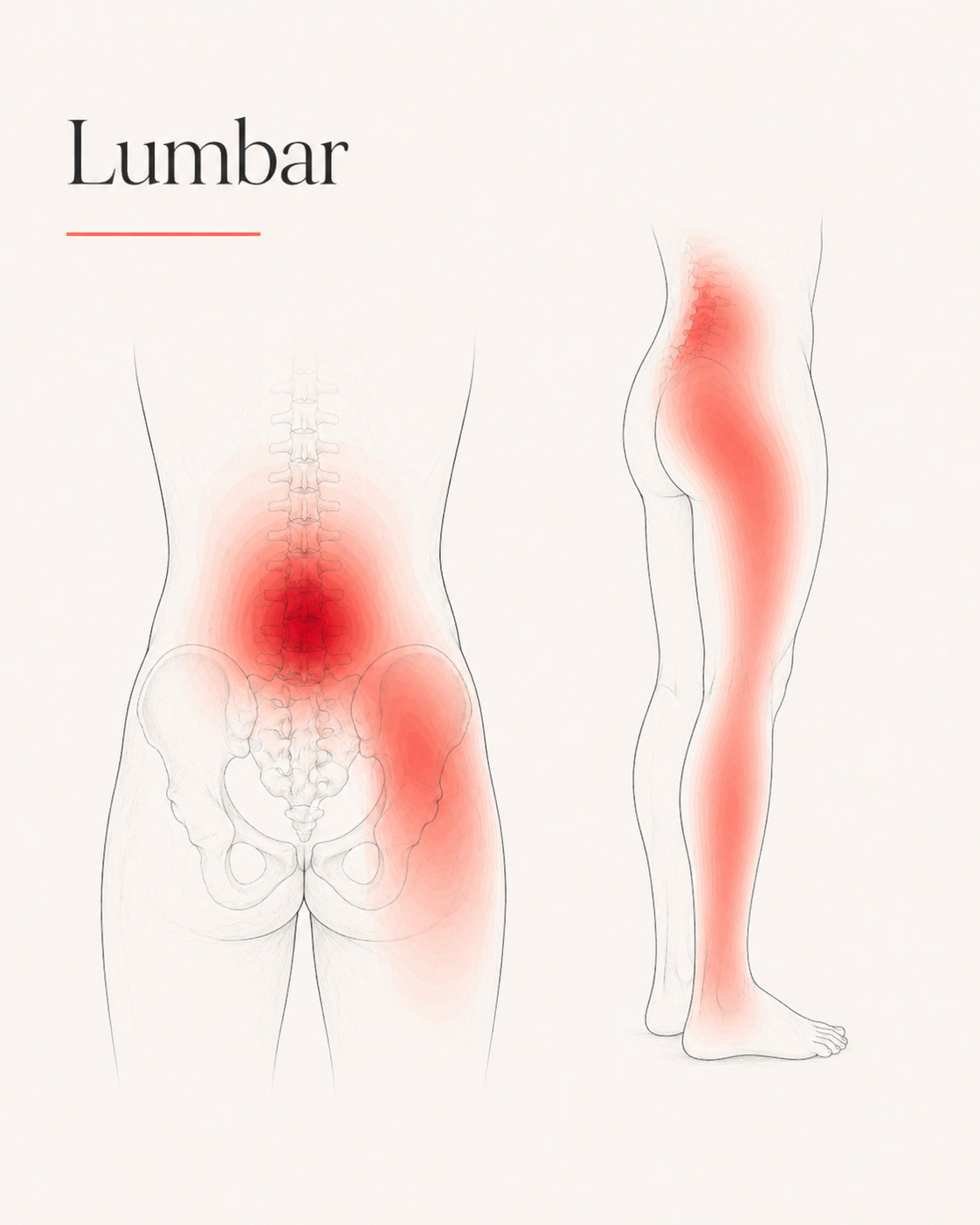 Lumbar pain pattern