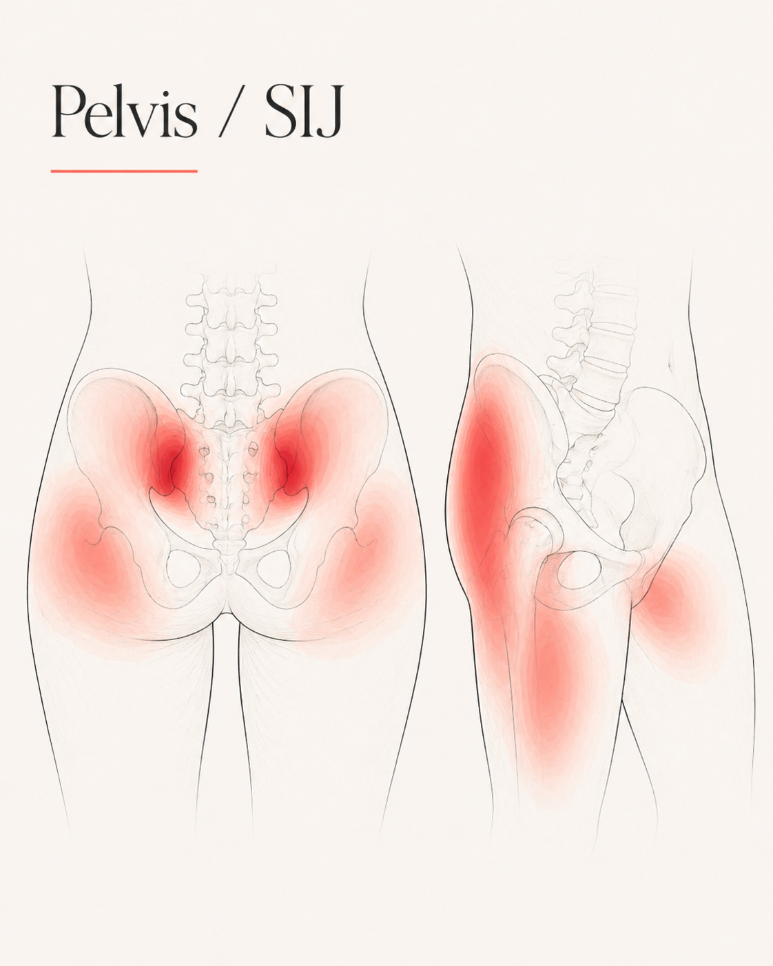 SIJ and Pelvis pain pattern