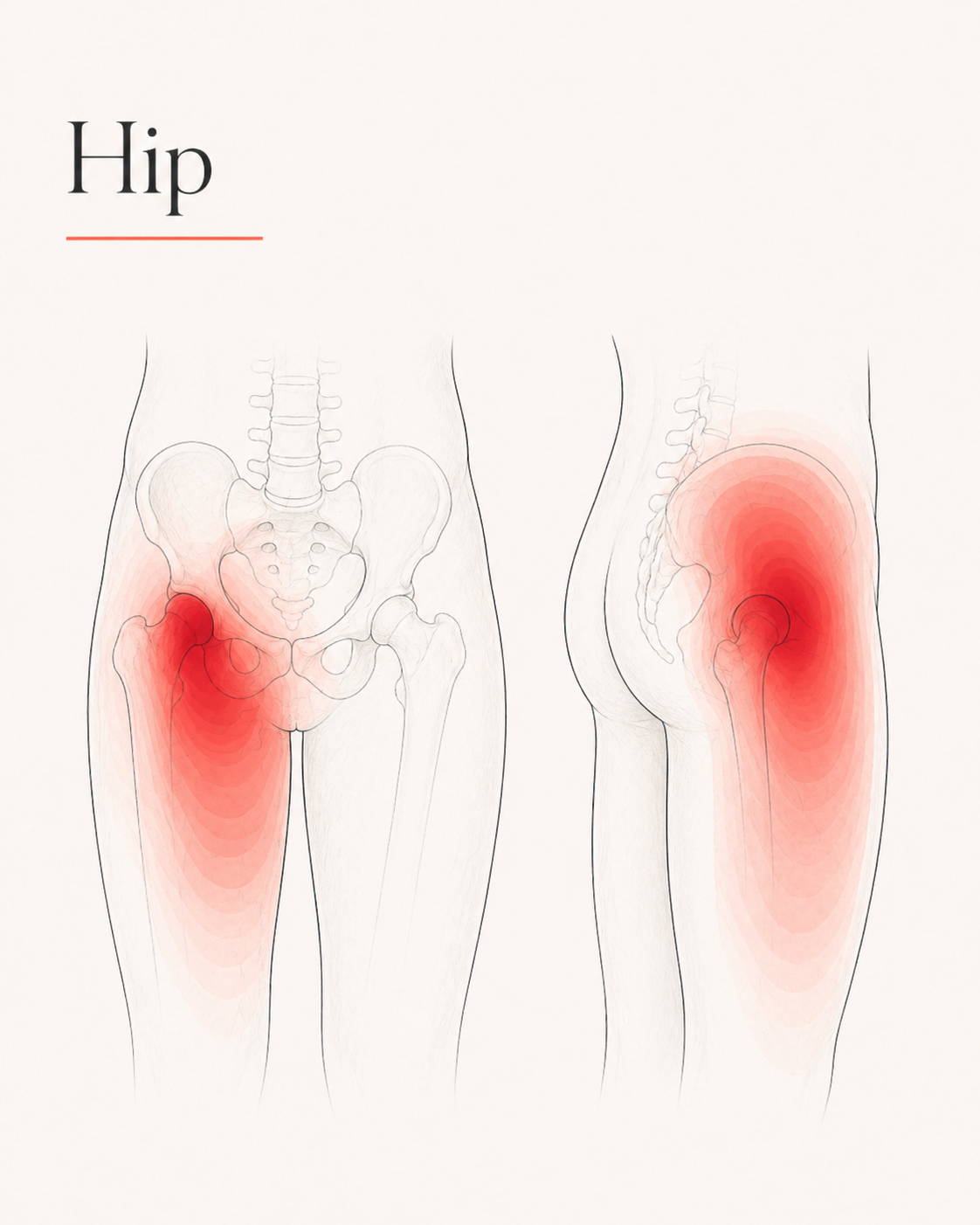 Hip pain pattern