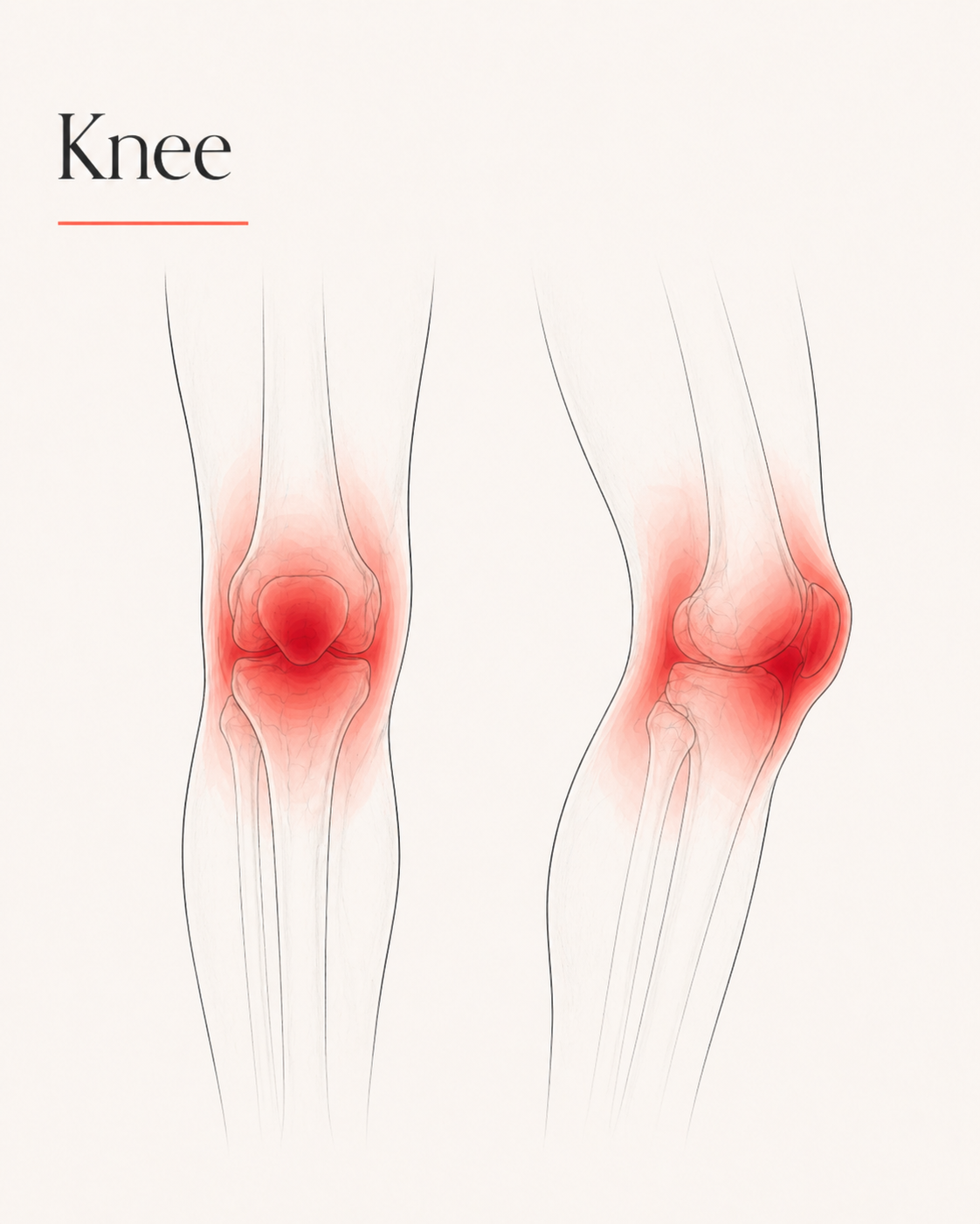 Knee pain pattern